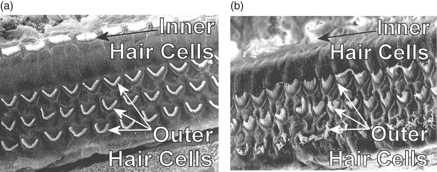 Photos depict electron microscope image of the hair cells in the cochlea (a) hairs cells before noise exposure and (b) damaged hair cells after intense noise exposure.